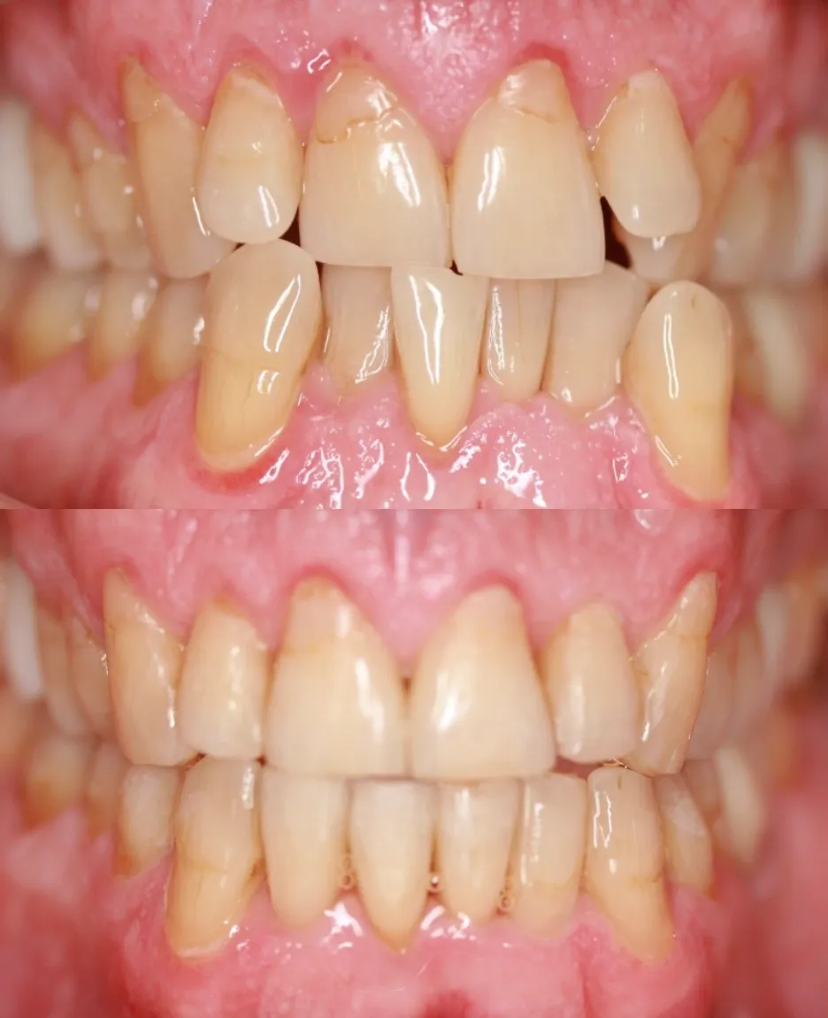 Före- och efterbild: Invisalign